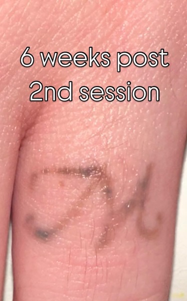 Tattoo Removal After