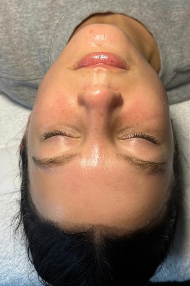 After Dermaplane Facial