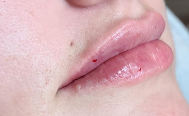 Lip Filler After