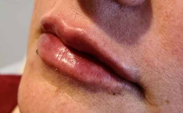 Lip Filler After