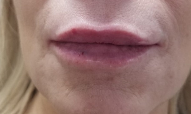 Lip Filler After