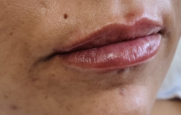 Lip Filler After