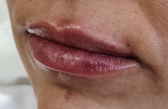 Lip Filler After