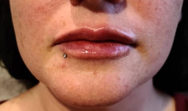 Lip Filler After