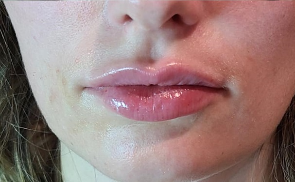 Lip Filler After
