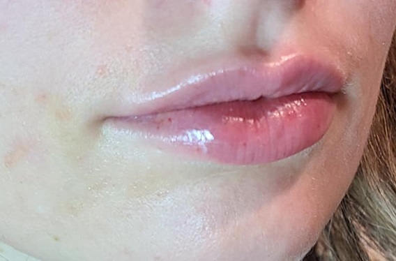 Lip Filler After