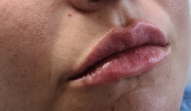 Lip Filler After
