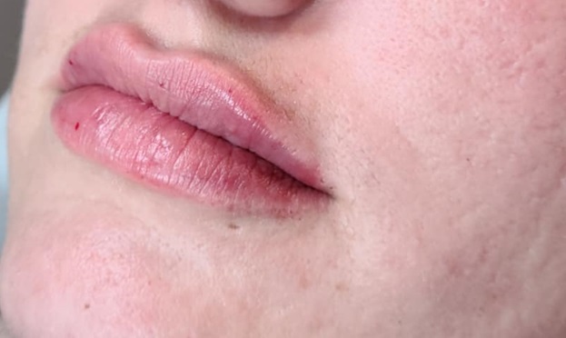 Lip Filler After