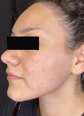 PCA Peels After