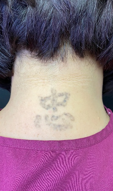 Tattoo Removal After