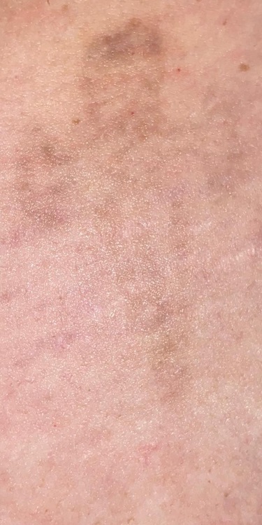 Tattoo Removal After