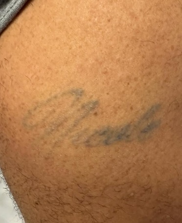 Tattoo Removal After