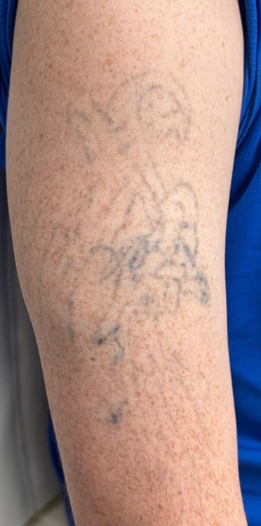 Tattoo Removal After
