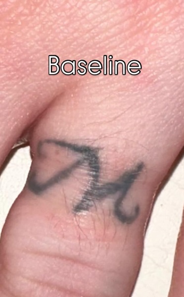 Tattoo Removal Before