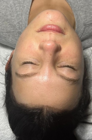 Before Dermaplane Facial