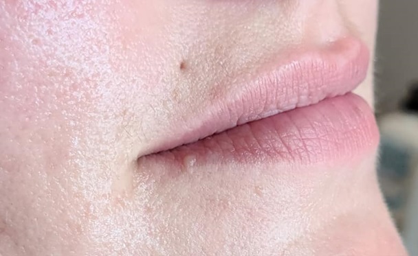 Lip Filler Before