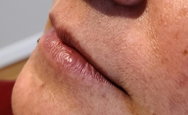 Lip Filler Before