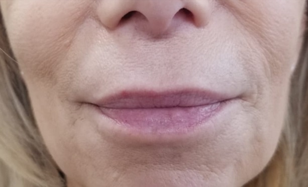 Lip Filler Before