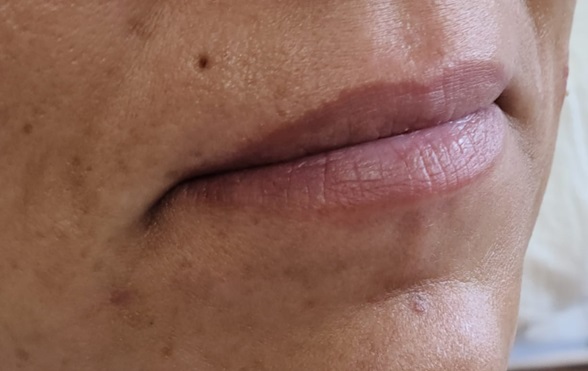 Lip Filler Before
