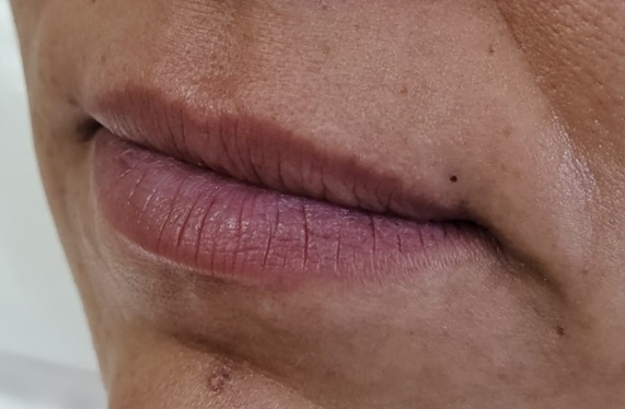 Lip Filler Before