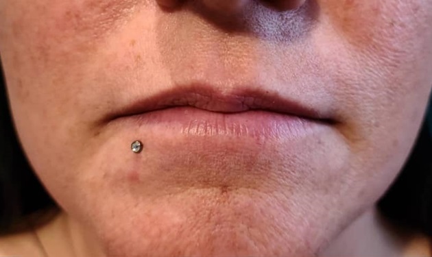 Lip Filler Before