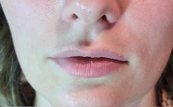 Lip Filler Before