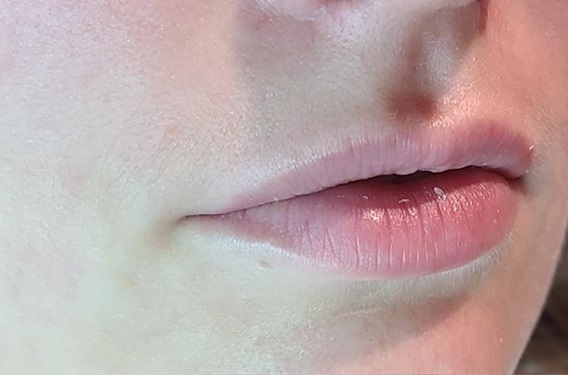 Lip Filler Before