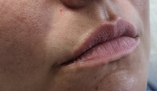 Lip Filler Before