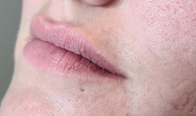 Lip Filler Before