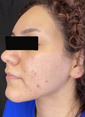 PCA Peels Before