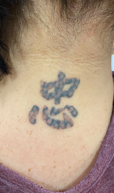 Tattoo Removal Before