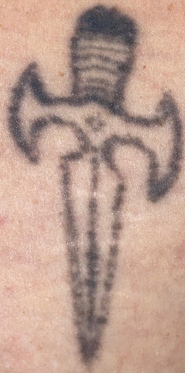 Tattoo Removal Before
