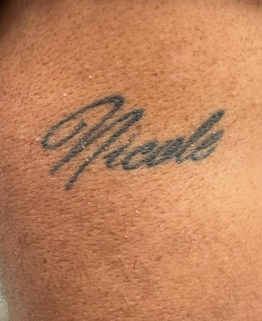 Tattoo Removal Before