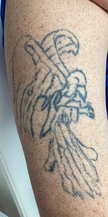 Tattoo Removal Before